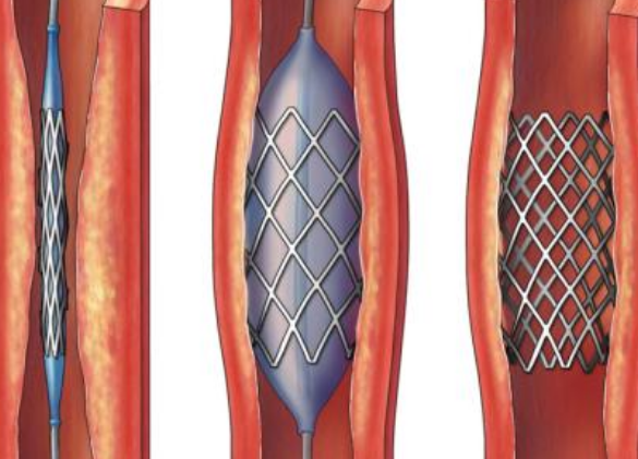 好消息！700元冠脈支架來了帶量采購結果在甘肅省正式落地執(zhí)行